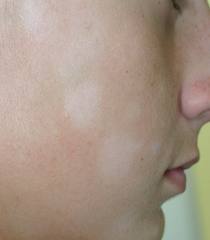 Psoriasi di crema di piede